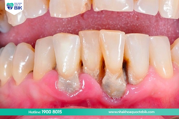 How to treat loose teeth?