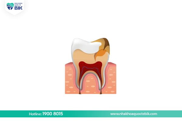 Sầu dentin caries