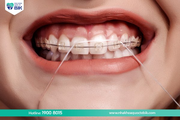 Cleaning braces with dental floss