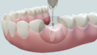 cấy ghép implant