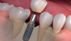 cấy ghép implant