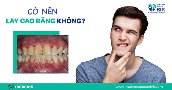 Có Nên Lấy Cao Răng Hay Không?