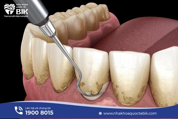 What is dental scaling?