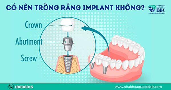 Có nên trồng răng implant không? Những trường hợp nên trồng implant