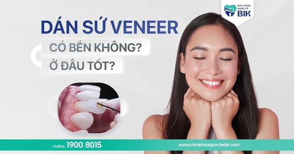 Dán Sứ Veneer Có Bền Không? Có Tốt Không?