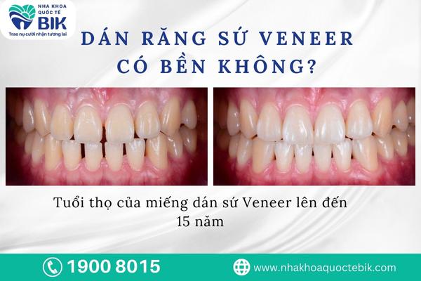 Are Veneer Porcelain Bonds Durable?