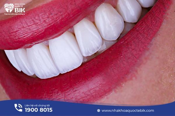 Advantages of porcelain veneers