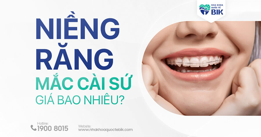 Niềng Răng Mắc Cài Sứ Bao Nhiêu Tiền?