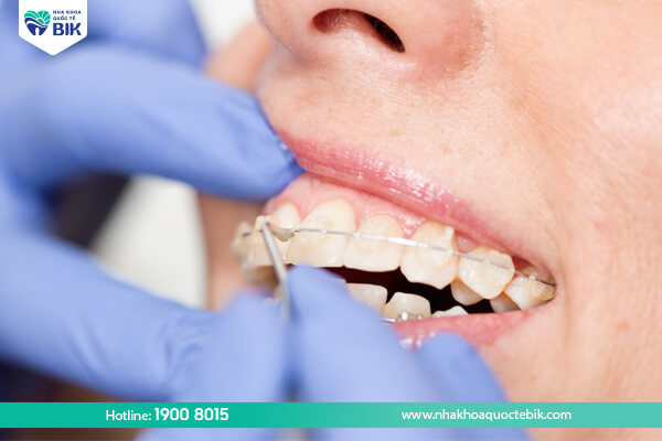 Limitations when wearing ceramic braces