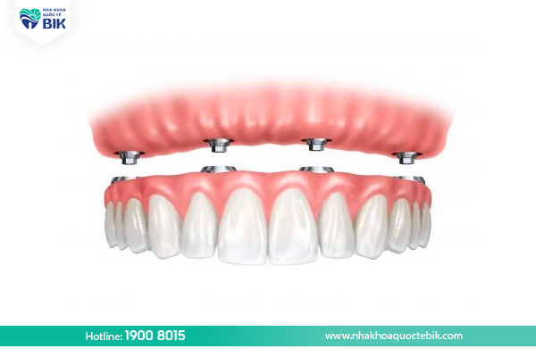 What is a removable denture on an implant?