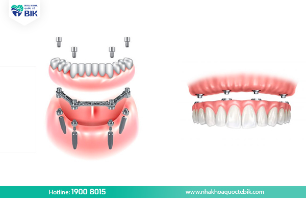 How many types of removable jaws on implants are there?