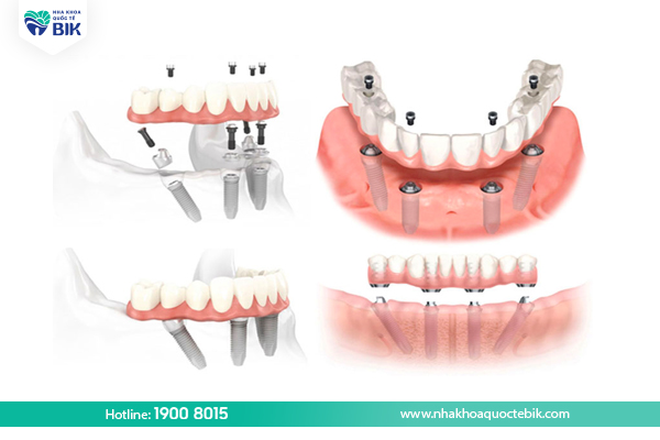 Procedure for making removable dentures on Implants