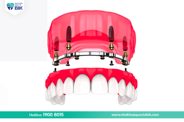 Advantages of making removable dentures on Implants