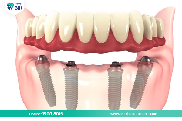 Limitations when using removable dentures on Implants