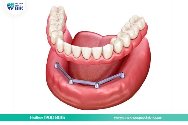 Notes when using removable dentures on Implants