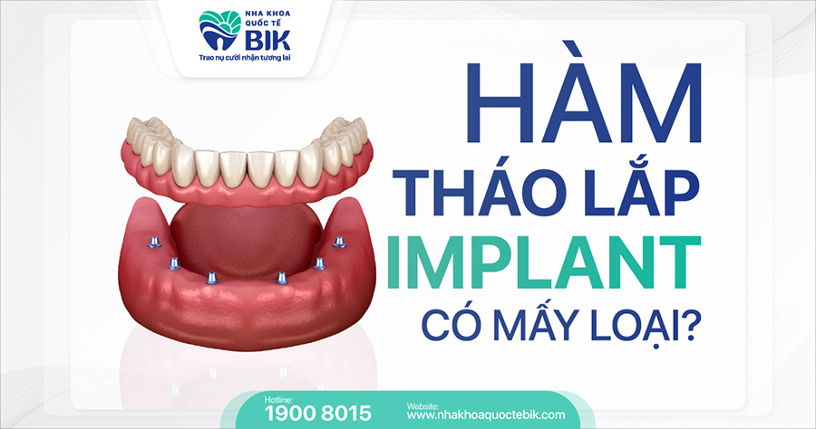 Hàm Tháo Lắp Trên Implant Là Gì? Có Mấy Loại?