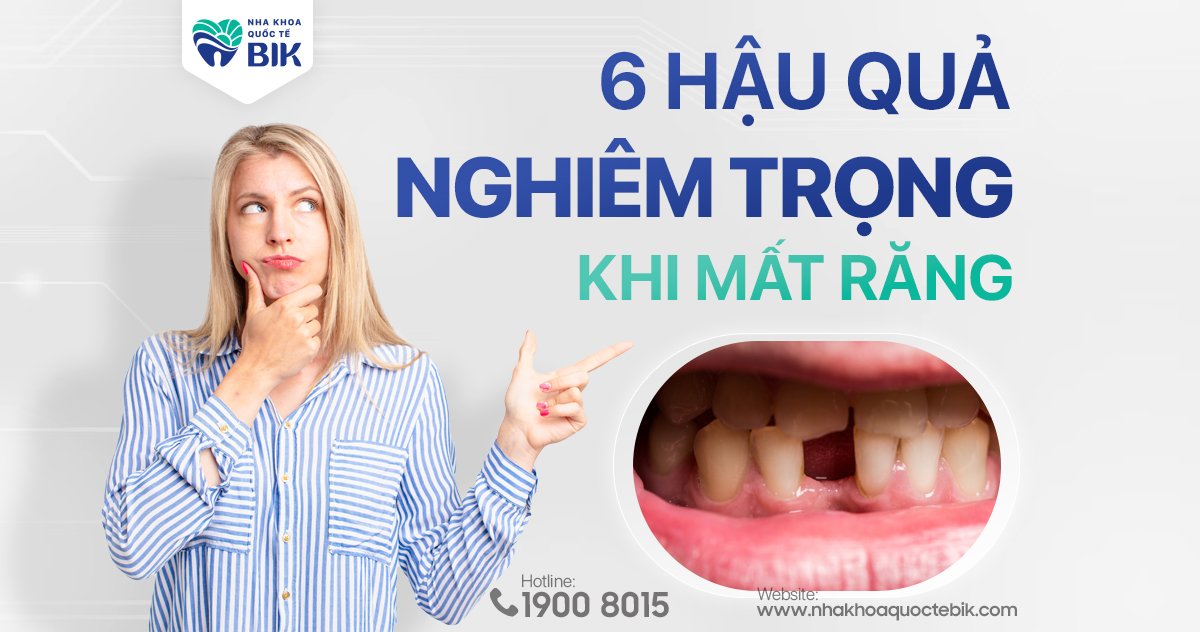 Hậu quả mất răng cực kỳ nghiêm trọng nhất định phải biết