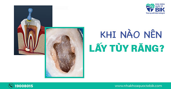 Khi Nào Nên Lấy Tủy Răng Tốt Nhất?