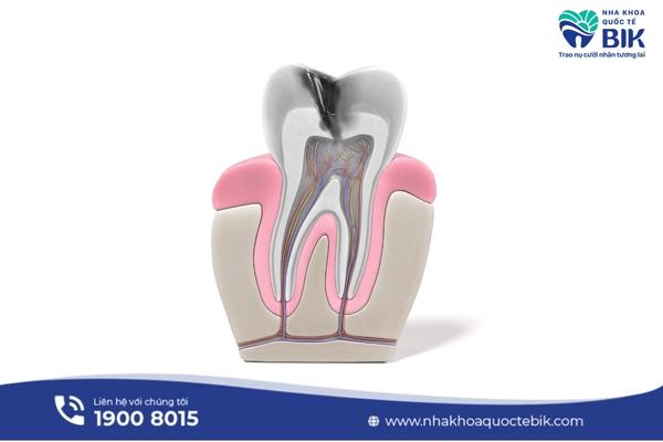 What is a root canal?