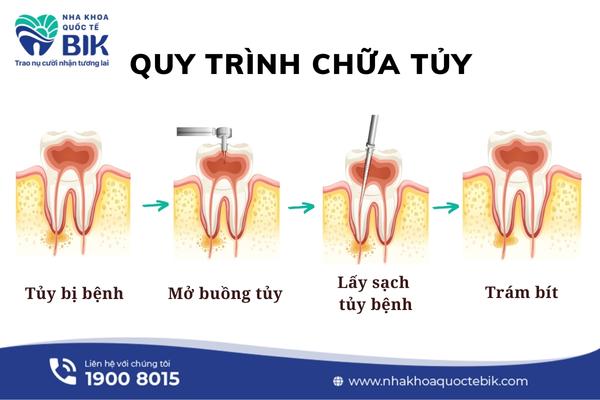 Root canal treatment process