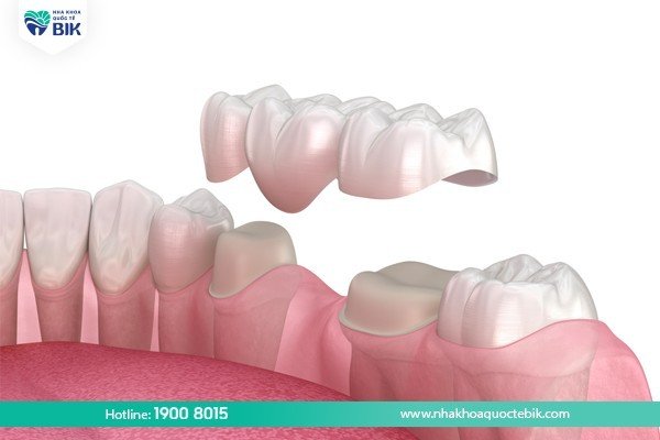 Should I get a porcelain bridge?