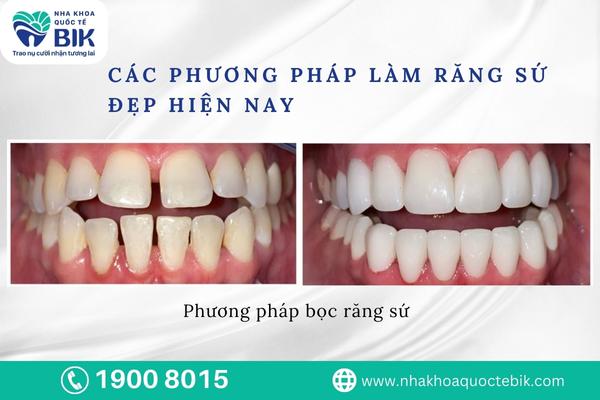 Current methods of making beautiful porcelain teeth