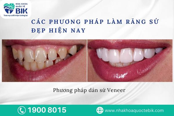 Dán răng sứ Veneer