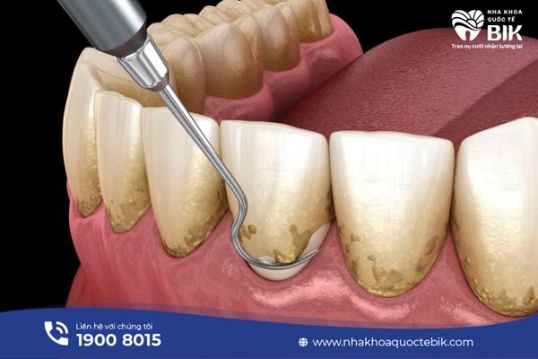 Does scaling whiten teeth?