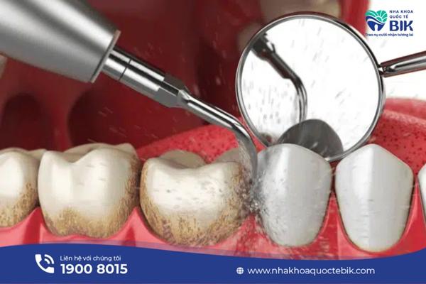 What is dental scaling?