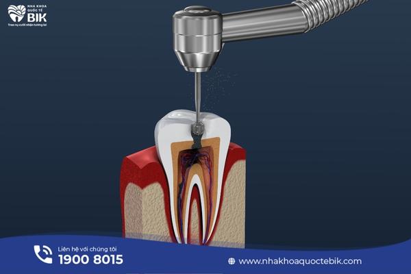 What is a root canal?