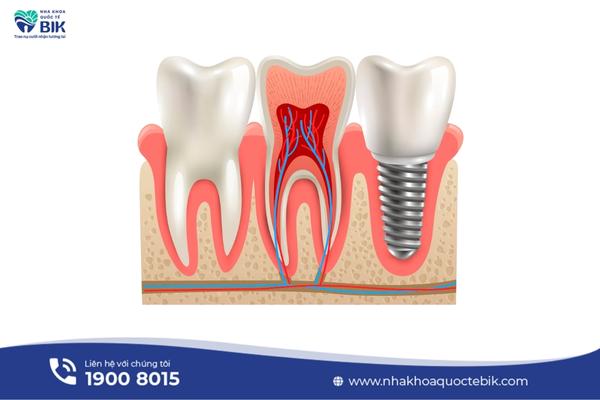 Root canal treatment process