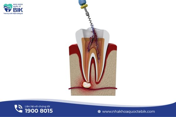 How long does a root canal tooth last?