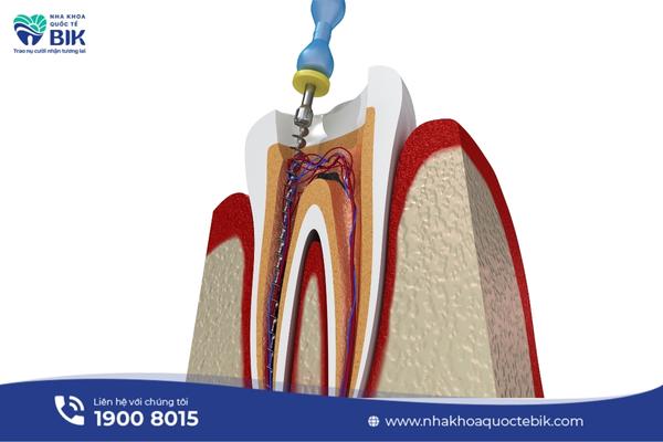 Complications that can occur after root canal treatment