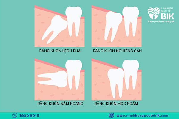 Is wisdom teeth extraction dangerous and what complications can occur