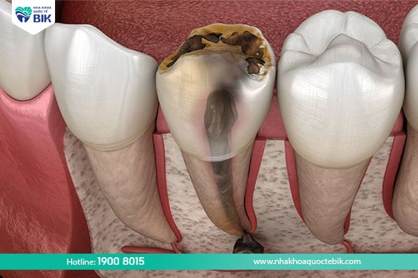 Why do you need to pull out the decayed upper molar?