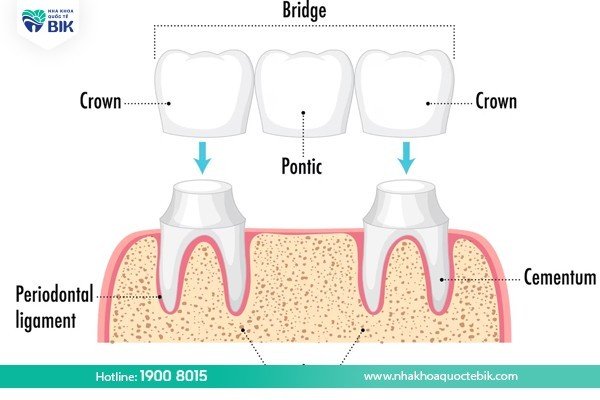 What are the benefits of porcelain bridges?