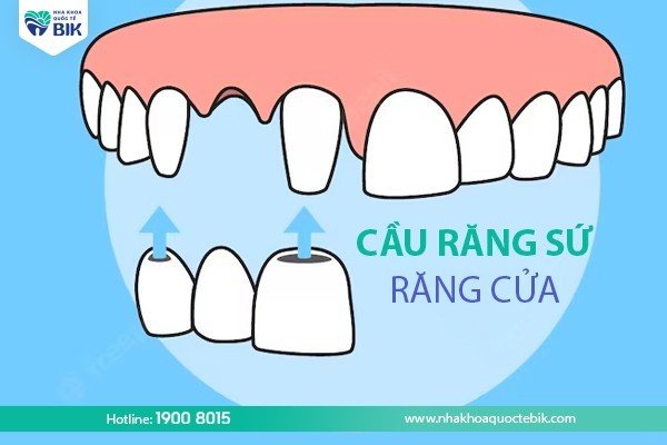 What are the disadvantages of porcelain bridges?