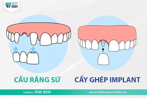 Implants overcome the disadvantages of porcelain bridges