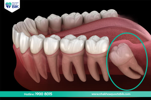 The role of wisdom teeth in jaw structure