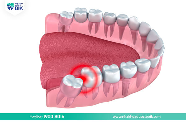 Why should wisdom teeth be removed when wearing braces?