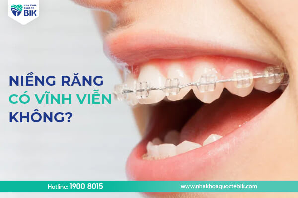 Niềng răng có được vĩnh viễn không?