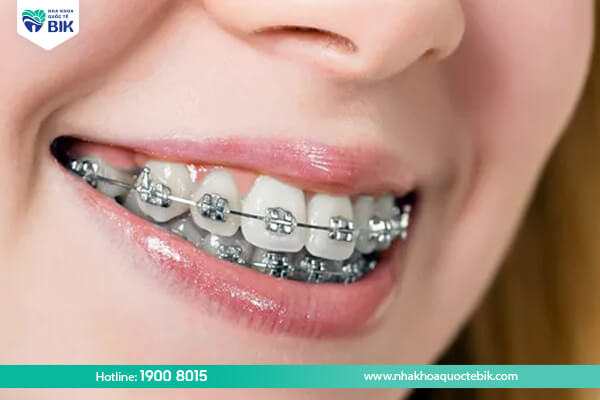 Metal braces