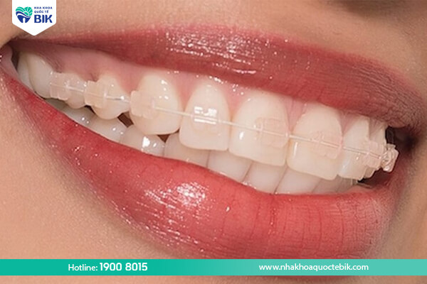 Ceramic braces