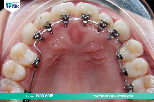 Lingual braces