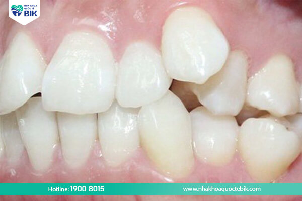 What to do if teeth are repositioned after braces?