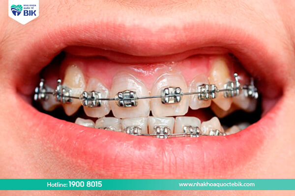 Is the second orthodontic treatment cheaper than the first?