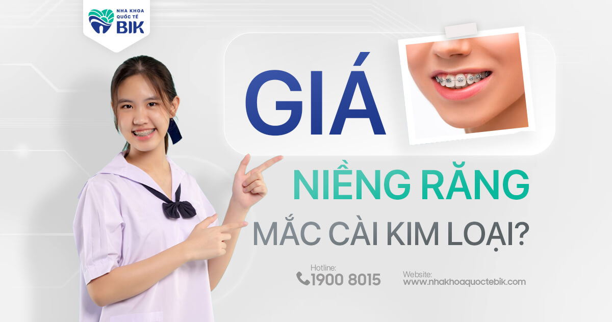 Niềng răng mắc cài kim loại