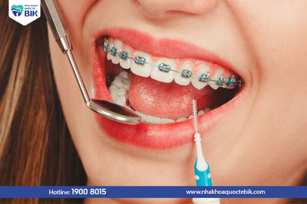 How to take care of your teeth when wearing braces?