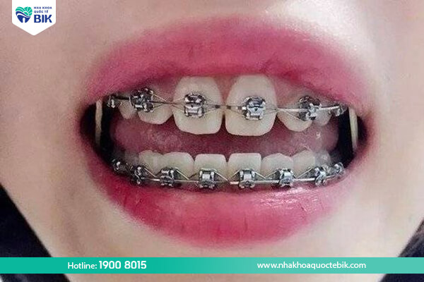 Metal braces for spaced teeth