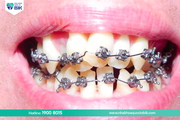 Metal braces for crooked teeth